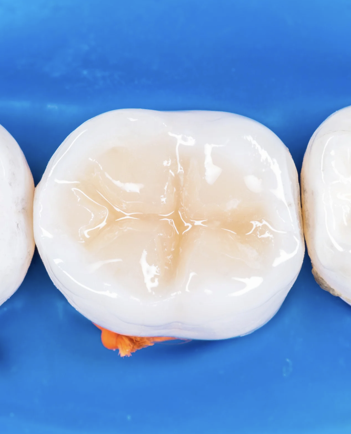 composite filling