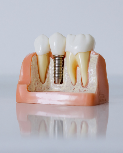 dental implants