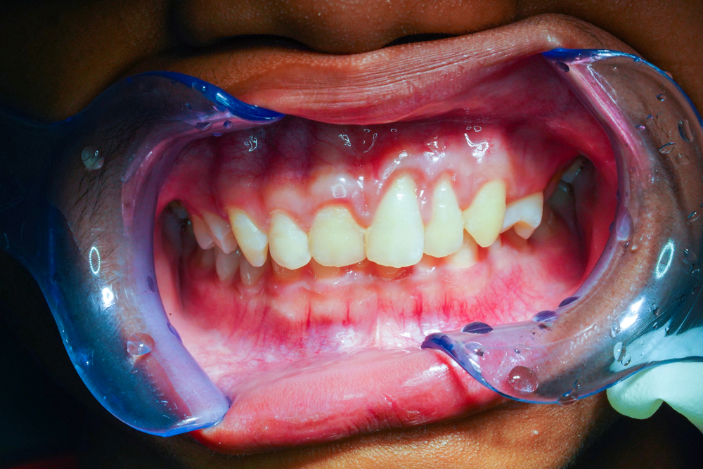 gum disease